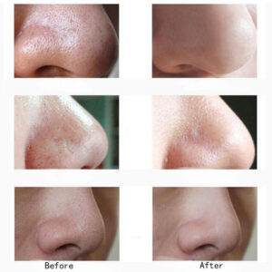 Blackhead Remover Vacuum Acne Cleaner Black Spots Removal